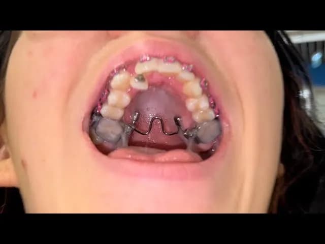 Jak przekręcać aparat Hassa, aby uniknąć bólu i uszkodzeń? Jak przekręcać aparat Hassa, aby uniknąć bólu i uszkodzeń?